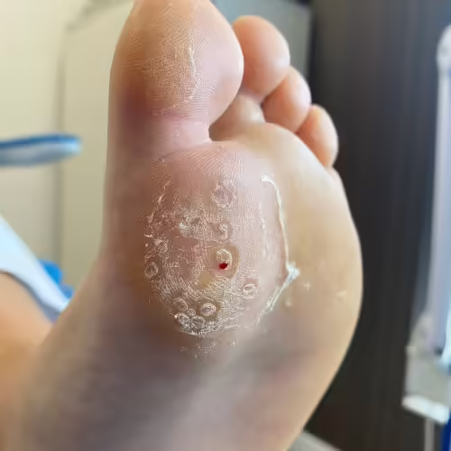 Papiloma